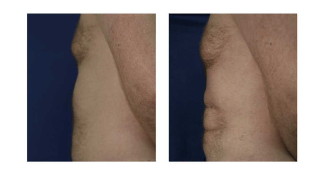 lipo before and after